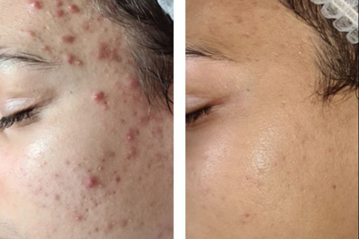 Zimna Plazma Dr Platon (Plasma Shower) 1 Zimna Plazma Dr Platon (Plasma Shower)