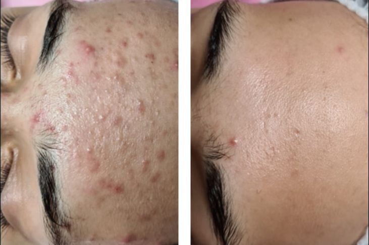 Zimna Plazma Dr Platon (Plasma Shower) 2 Zimna Plazma - trądzik młodzieńczy, dorosły oraz różowaty