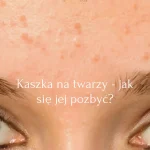 KASZKA NA TWARZY - JAK SIĘ JEJ POZBYĆ_1