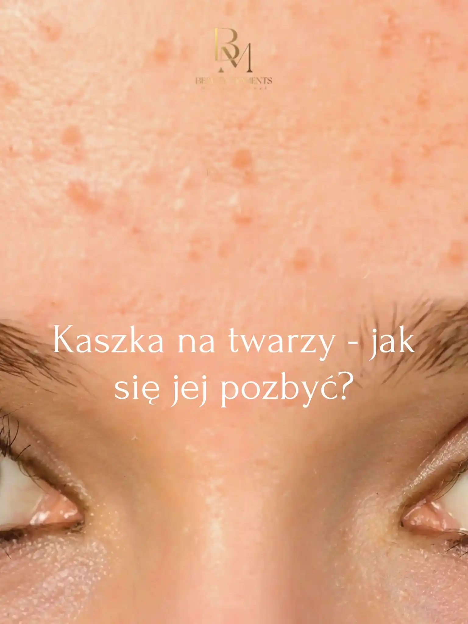 Blog 7 KASZKA NA TWARZY - JAK SIĘ JEJ POZBYĆ_1