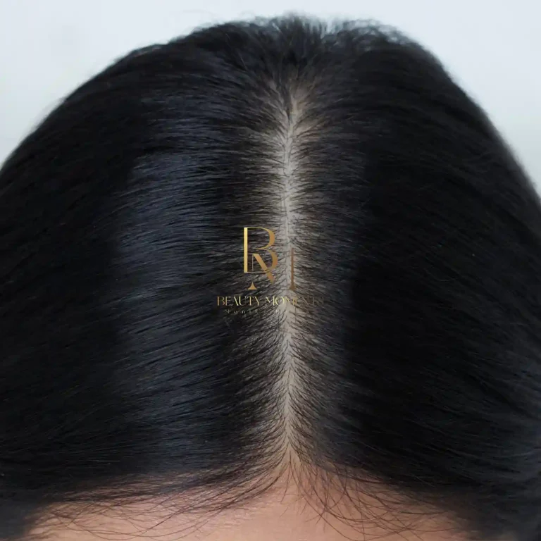 Mezoterapia Igłowa Skóry Głowy – Dr Cyj Hair