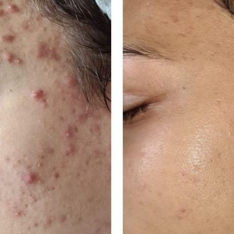 Zimna Plazma Dr Platon (Plasma Shower)